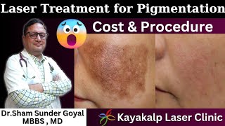 Laser Treatment for Pigmentation Cost  Melasma Removal  Hyperpigmentation  Face Melasma [upl. by Panchito]