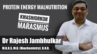 PROTEIN ENERGY MALNUTRITION PEM Kwashiorkor and Marasmus [upl. by Ulane]