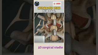 Herniated Disk Removal  New surgical video newvideo surgicalinstruments medicalacademywallah [upl. by Ennybor734]