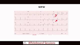 EDExam Whiteboard Session Dont Miss These ECGs Part 1 [upl. by Yahsan]