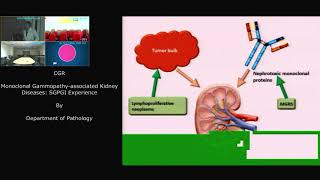 Monoclonal Gammopathy associated Kidney [upl. by Seline144]