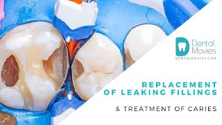 Replacement of leaking fillings amp treatment of caries [upl. by Annahsat]