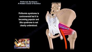 Piriformis Syndrome A Hidden Cause of Sciatica  piriformis syndrome causes diagnosis and treatment [upl. by Melac502]