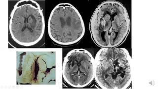 Hemorragia intracraneal [upl. by Silverstein]