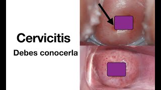 Cervicitis  Causas síntomas diagnóstico y tratamiento  ETS [upl. by Alyakem50]