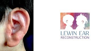 1piece Lewin Ear Heals over one year [upl. by Spiegleman]