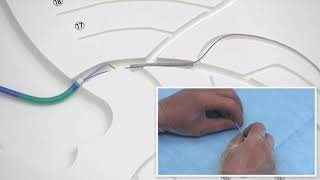 Angioplasty technique Retrieve of a stent migrated in the coronary artery English subtitle [upl. by Peedus]