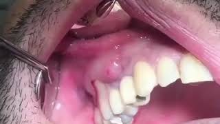 Popping a Tooth Abscess [upl. by Aniale]