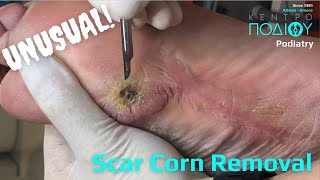 SCAR CORN ON DIABETIC FOOTΑΦΑΙΡΕΣΗ ΚΑΛΟΥ ΤΥΛΟΥΚέντρο Ποδιού PodiatryΠοδιατρική ΠοδολογίαΑθήνα [upl. by Ordisy]