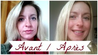 ACNE ❀ Roacutane mois après mois [upl. by Yelsel]