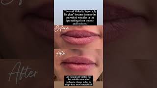 Natural lip injections volbella lipfiller lipfillerinjections [upl. by Kendre779]