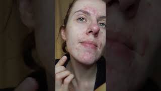 skincareroutine akne skinpicking skincare [upl. by Grayson480]