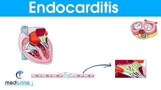 Endocarditis  causes symptoms pathophysiology diagnosis and treatment [upl. by Hamon]