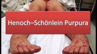 HenochSchönlein Purpura [upl. by Drusy]