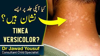 Tinea versicolor skin infection children  treatment  Causes  In Hindi Urdu Healers Online [upl. by Lotsirhc846]