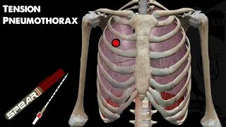 Tension Pneumothorax Education and Management [upl. by Odrareve]