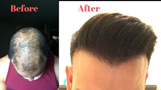 My Hair Transplant Journey [upl. by Aiekat581]