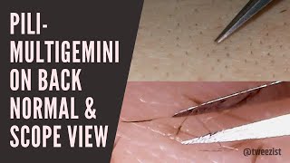 Tweezist Pilimultigemini removal from back normal and scope view [upl. by Rebbecca]