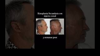 Rinoplastia secundaria con injerto costal [upl. by Betteann]