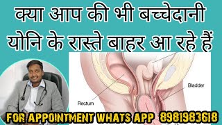 बच्चेदानी का योनि से बाहर आना prolapse of Uterus [upl. by Pump]