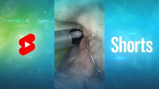 What is Endoscopic Lumbar Foraminotomy Shorts [upl. by Hadias]