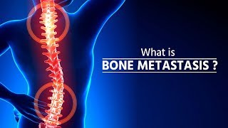 What is bone metastasis  Stage 4 Cancer  Bone Metastasis  How Cancer Spreads  metastasis [upl. by Herb]