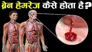 ब्रेन हेमरेज कैसे होता है और क्या होता है What Happens in Brain Hemorrhage [upl. by Drawdesemaj]