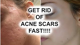 HOW TO GET RID OF ACNE SCARS  Pershii [upl. by Lucius]