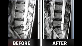 Disc Bulge  Herniated Disc A Physiotherapy and Chiropractic Treatment Approach [upl. by Yznel315]