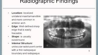 Adenomatoid Odontogenic Tumor [upl. by Isoais]