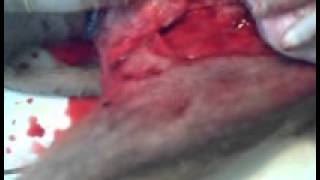 ablation tumeur testiculaire bergerwmv [upl. by Mulford]