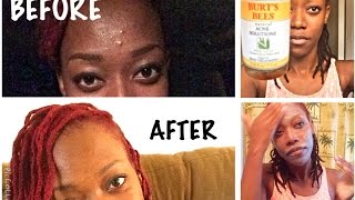 Burts Bees Natural Acne Solutions Review before and after [upl. by Atsylak]