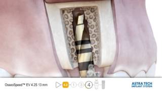 Astra Tech EV surgical animation [upl. by Lucia]