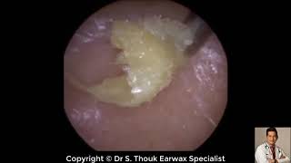 Top Biggest Ear Wax Removal 107  Ear wax Extraction  Dr S Thouk Earwax Specialist [upl. by Drofniw846]