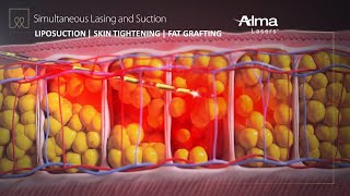 Liposuction Skin Tightening amp Fat Grafting  Lipo Life by Alma Lasers Medical Device 3D Animation [upl. by Heimer]