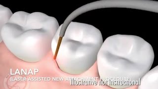 How Does Laser Surgery Work Treat Gum Disease  LANAP [upl. by Warring]