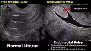 Uterus Ultrasound Normal Vs Endometrial Polyp Images  Feeding Artery Interrupted Mucosa Sign USG [upl. by Munster]