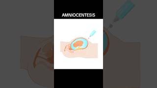 AMNIOCENTESIS amniocentesis  WHAT IS AMNIOCENTESIS shortsviraltrending [upl. by Adnesor]