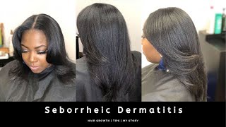 Seborrheic Dermatitis  Hair Growth  Tips amp My Story PT 2 [upl. by Noiramed]