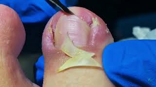 Dig Out Ingrown Toenails FAST with These Simple Steps [upl. by Elfstan]