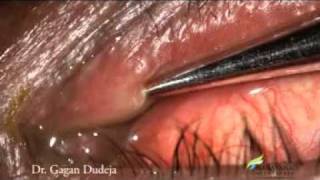 Mini Monoka Stent for Punctal Stenosis [upl. by Nolie672]