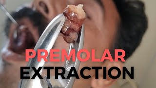 Premolar extraction  Upper premolar extraction  Second premolar extraction [upl. by Matuag]