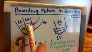 Bounding Pulses in Aortic Regurgitation [upl. by Anaerb]