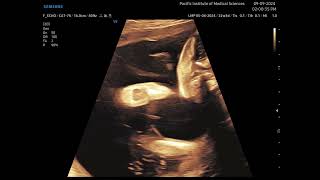 Arthrogryposis Multiplex congenita fetal ultrasound [upl. by Ailelc]