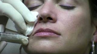 Juvederm Ultra Injection to NasoLabial Folds laugh lines by Reston Virginia Cosmetic Surgeon [upl. by Ellinad]