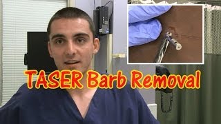 TASER Barb Removal [upl. by Gianna430]