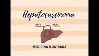 Hepatocarcinoma Introducción [upl. by Ylrahc499]