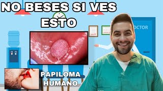 NO BESES SI ALGUIEN TIENE VPH BUCAL  HPV BUCAL  VIRUS DEL PAPILOMA HUMANO  DAVID CAMPOS [upl. by Airamzul993]