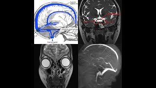 EXAM SPOTTERS VIVA How to read MRI brain amp PNS Anatomy of Dural venous sinuses amp ICA on MRI [upl. by Acnairb]