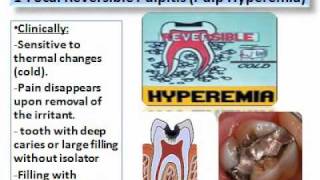 Pulp Diseases Oral Pathologywmv [upl. by Darra289]